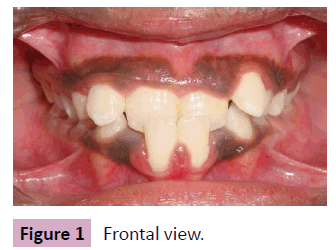 Anterior Cross Bite Insight Medical Publishing