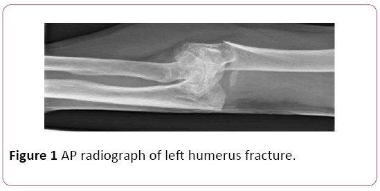 elbow humerus fracture