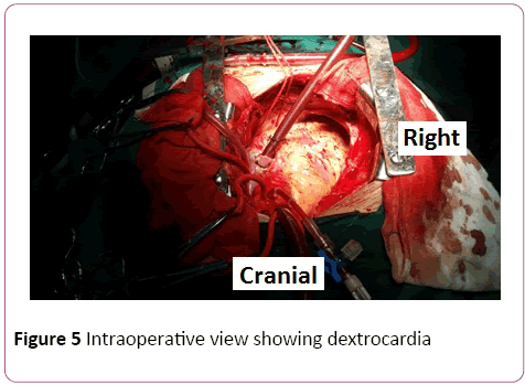 Double Valve Replacement In A Patient With Dextrocardia And Situs Inversus Toatalis A Case Report Insight Medical Publishing