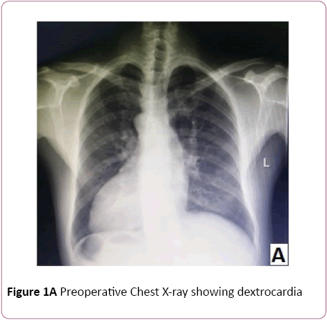 Double Valve Replacement In A Patient With Dextrocardia And Situs Inversus Toatalis A Case Report Insight Medical Publishing