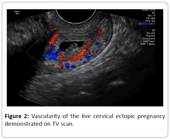 Management Of Live Cervical Ectopic Pregnancy Insight Medical Publishing